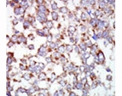 IHC analysis of FFPE human hepatocarcinoma tissue stained with the TAK1 antibody.