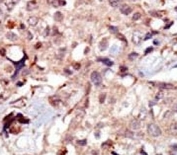 IHC analysis of FFPE human breast carcinoma tissue stained with the MLCK antibody.