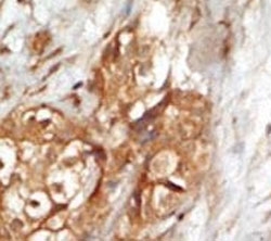 IHC analysis of FFPE human breast carcinoma tissue stained with the NIK antibody~