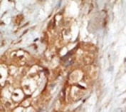 IHC analysis of FFPE human breast carcinoma tissue stained with the NIK antibody