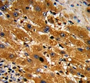IHC analysis of FFPE human hepatocarcinoma with Caspase-9 antibody