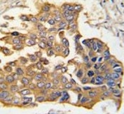 IHC analysis of FFPE human lung carcinoma tissue stained with Caspase-9 antibody