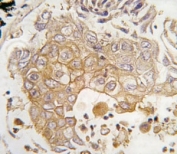 IHC analysis of FFPE human lung carcinoma tissue stained with CYP1A1 antibody
