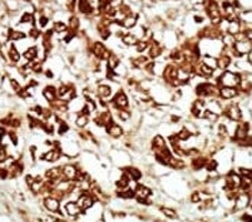 IHC analysis of FFPE human hepatocarcinoma tissue stained with the ZAK antibody