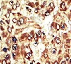 IHC analysis of FFPE human hepatocarcinoma tissue stained with the WEE1 antibody~