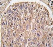 IHC analysis of FFPE human lung carcinoma tissue stained with IKK beta antibody