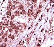 IHC analysis of FFPE human hepatocarcinoma tissue stained with the GSK3B antibody