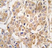 IHC analysis of FFPE human breast carcinoma tissue stained with the IKKE antibody