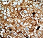 IHC analysis of FFPE human hepatocarcinoma tissue stained with the PFKFB3 antibody