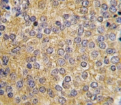 IHC analysis of FFPE human prostate carcinoma tissue stained with Urokinase antibody