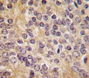 IHC analysis of FFPE human prostate carcinoma tissue stained with UPA antibody