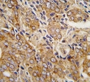 IHC analysis of FFPE human prostate carcinoma tissue stained with TRPM8 antibody