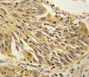 IHC analysis of FFPE human lung carcinoma with IL-1B antibody