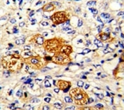 IHC analysis of FFPE human breast carcinoma with C5 antibody