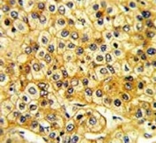 IHC analysis of FFPE human hepatocarcinoma with Src antibody