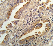 IHC analysis of FFPE human lung carcinoma stained with IL-8 antibody