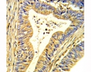 IHC analysis of FFPE human colon carcinoma stained with SOD1 antibody