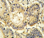 IHC analysis of FFPE human colon carcinoma stained with SOCS1 antibody