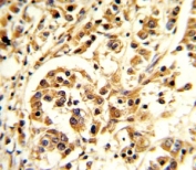 IHC analysis of FFPE human breast carcinoma stained with IL-12 antibody