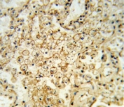 IHC analysis of FFPE human lung carcinoma stained with HLA-G antibody
