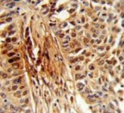 IHC analysis of FFPE human lung carcinoma stained with PIN1 antibody