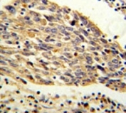 PKM2 antibody IHC analysis in formalin fixed and paraffin embedded human lung carcinoma.