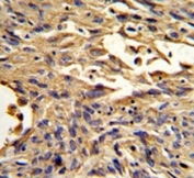 IHC analysis of FFPE human lung carcinoma stained with S100A10 antibody