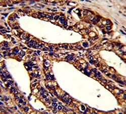IHC analysis of FFPE human prostate carcinoma stained with ORAI1 antibody~