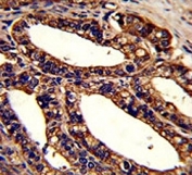 IHC analysis of FFPE human prostate carcinoma stained with ORAI1 antibody