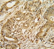 MCM2 antibody immunohistochemistry analysis in formalin fixed and paraffin embedded human colon carcinoma.