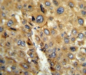 IHC analysis of FFPE human hepatocarcinoma stained with TAT antibody