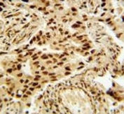 HDAC2 antibody immunohistochemistry analysis in formalin fixed and paraffin embedded human lung carcinoma
