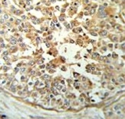 STING antibody IHC analysis in formalin fixed and paraffin embedded breast carcinoma.