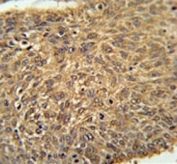 ATG13 antibody immunohistochemistry analysis in formalin fixed and paraffin embedded human lung carcinoma.
