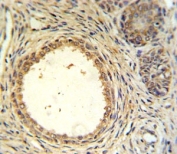 AMH antibody IHC analysis in formalin fixed and paraffin embedded prostate carcinoma.