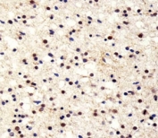 Immunohistochemical analysis of paraffin-embedded human astroglioma section using UCHL1 antibody at 1:25 dilution.