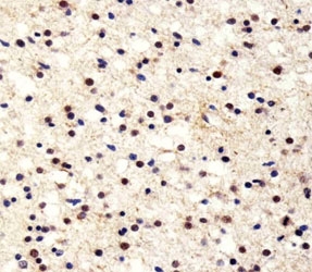 Immunohistochemical analysis of paraffin-embedded human astroglioma section using UCHL1 antibody at 1:25 dilution.