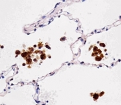 Immunohistochemical analysis of paraffin-embedded human lung using FABP4 antibody at 1:25 dilution.