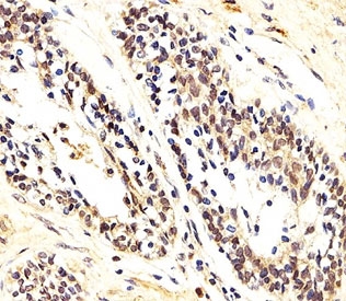 IHC analysis of FFPE human prostate carcinoma section using AKT1/2/3 antibody; Ab was diluted at 1:25.~