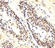IHC analysis of FFPE human prostate carcinoma section using AKT1/2/3 antibody; Ab was diluted at 1:25.