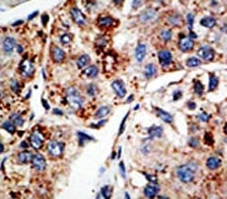 IHC analysis of FFPE human hepatocarcinoma tissue stained with the KMT4 antibody