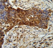 MMP2 antibody immunohistochemistry analysis in formalin fixed and paraffin embedded human lung carcinoma.