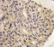 IHC analysis of FFPE human hepatocarcinoma tissue stained with PINK1 antibody