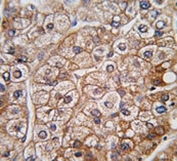 IHC analysis of FFPE human hepatocarcinoma tissue stained with BMPR2 antibody~