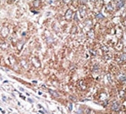IHC analysis of FFPE human hepatocarcinoma tissue stained with the Nestin antibody~