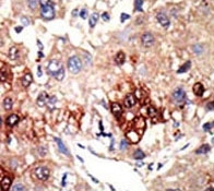 IHC analysis of FFPE human hepatocarcinoma tissue stained with the EZH2 antibody