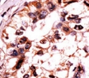 IHC analysis of FFPE human hepatocarcinoma tissue stained with the ERK3 antibody.