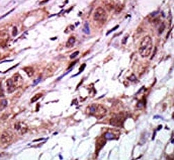 IHC analysis of FFPE human breast carcinoma tissue stained with the AURKC antibody