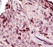 IHC analysis of FFPE human breast carcinoma tissue stained with the IRAK4 antibody