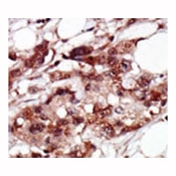 IHC analysis of FFPE human breast carcinoma tissue stained with the BRD4 antibody~